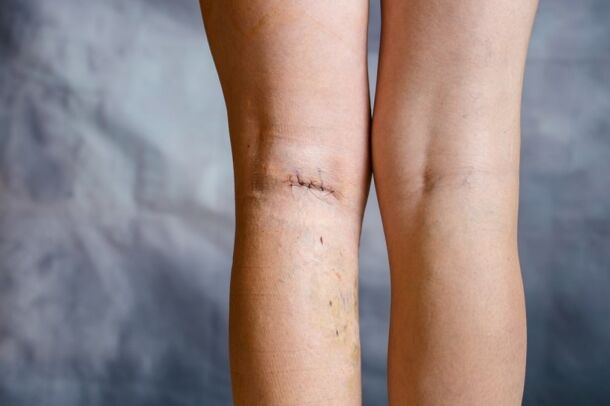Suture sur la jambe après chirurgie des varices