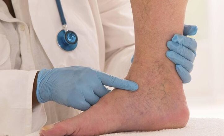 le médecin examine la jambe avec des varices