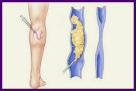 La sclérothérapie est un moyen populaire de se débarrasser des varices sur les jambes
