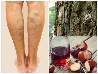 le traitement de veine sur les jambes remèdes populaires