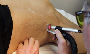 traitement des varices au laser