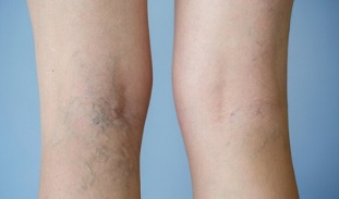Signes de varices dans les jambes chez les femmes